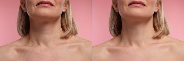 Image of Aging skin changes. Collage with photos of mature woman before and after cosmetic procedure on pink background, closeup