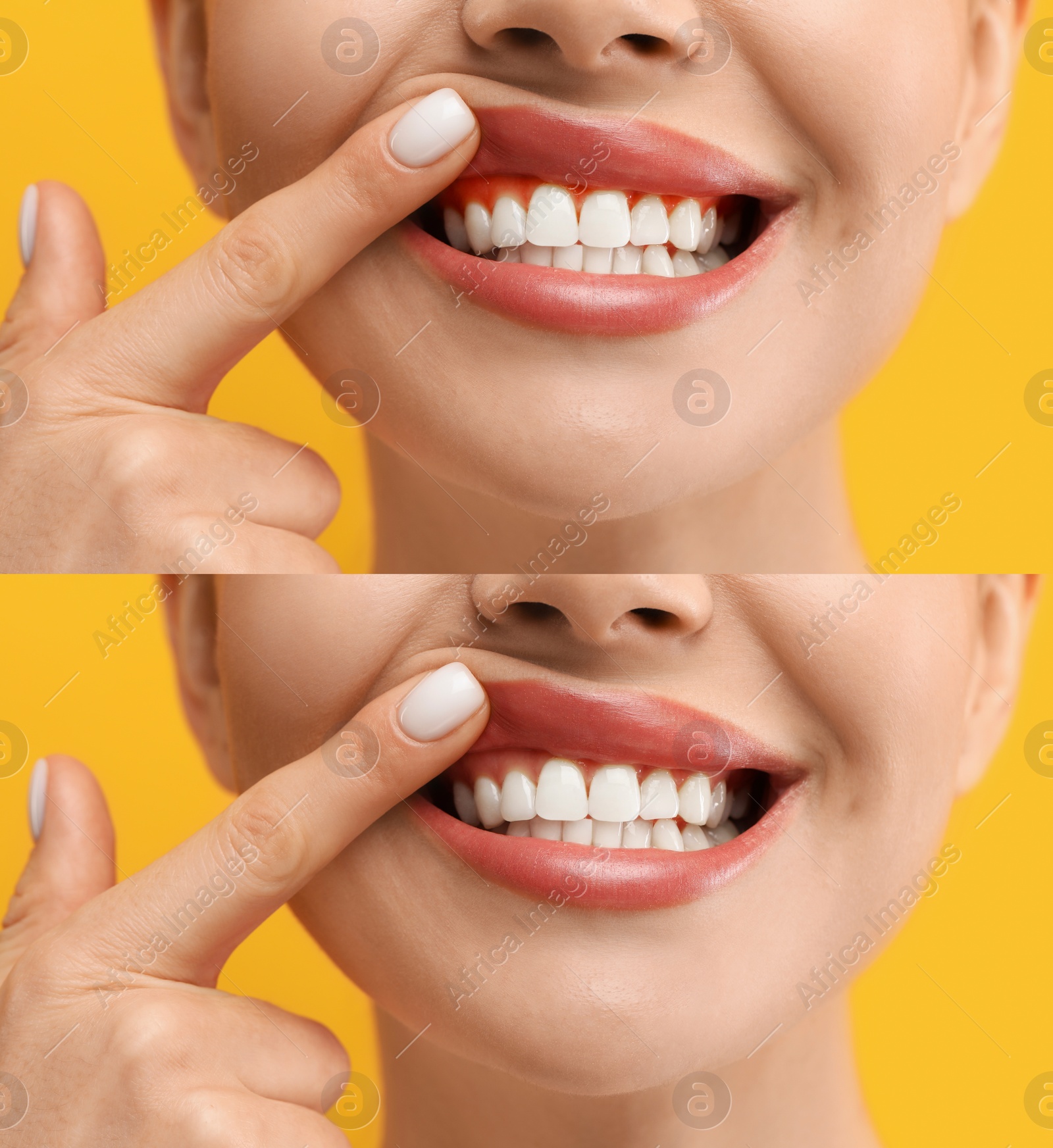 Image of Woman showing gum before and after treatment on orange background, collage of photos