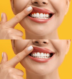 Woman showing gum before and after treatment on orange background, collage of photos