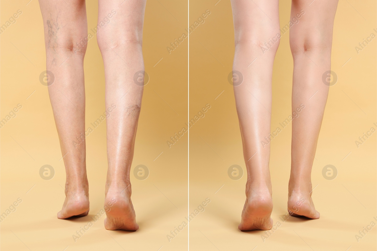 Image of Before and after varicose veins treatment. Collage with photos of woman showing legs on yellow background, closeup