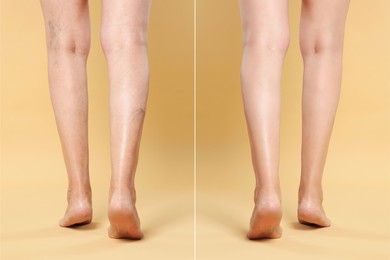 Image of Before and after varicose veins treatment. Collage with photos of woman showing legs on yellow background, closeup