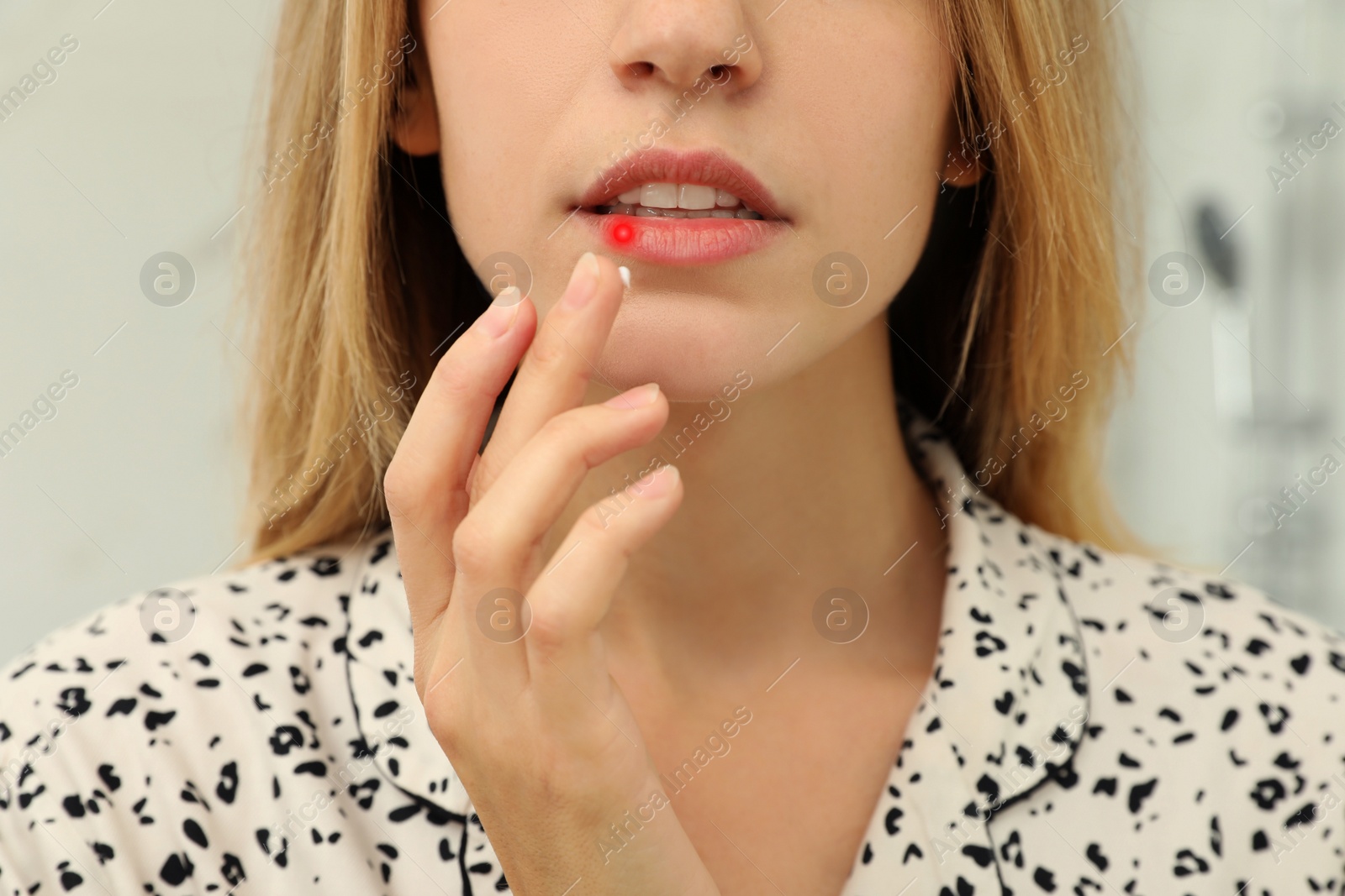 Image of Woman with herpes applying cream onto lip on blurred background, closeup