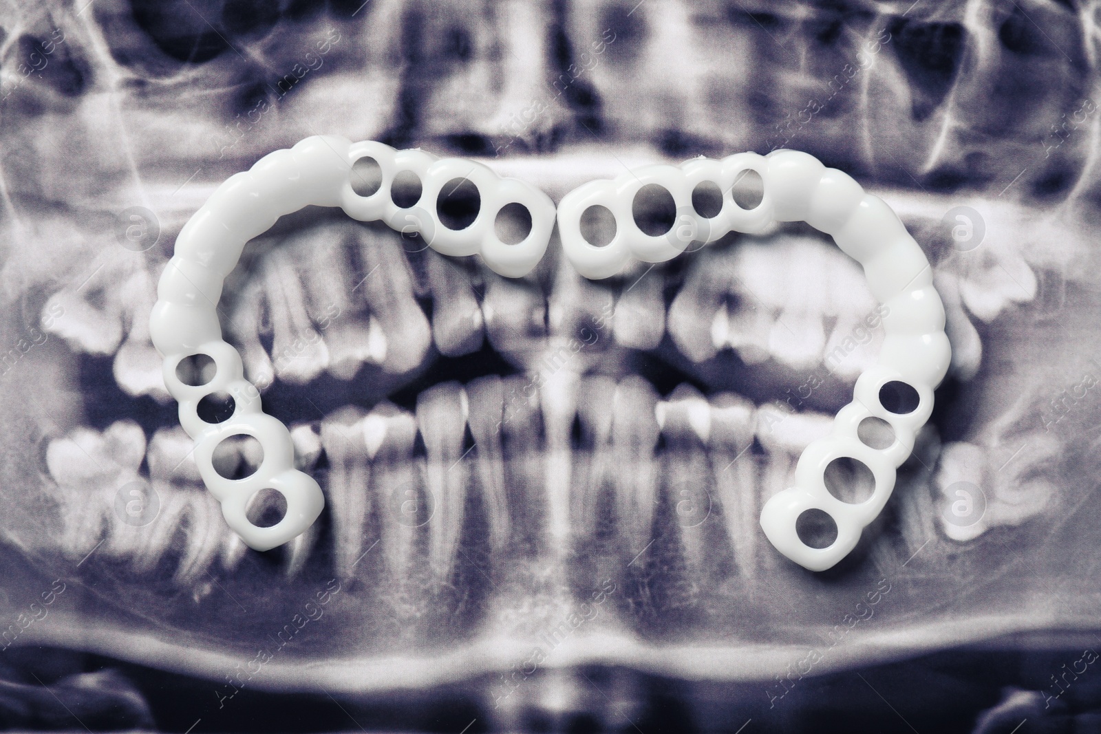 Photo of Mouth guards on dental scan, flat lay. Bite correction