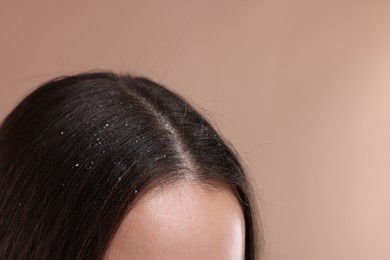 Photo of Woman with dandruff problem on beige background, closeup. Space for text