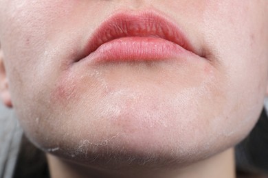 Photo of Woman with dry skin on face, closeup