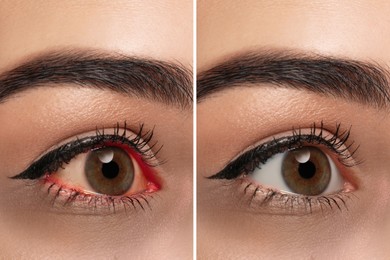 Image of Collage with photos of woman before and after conjunctivitis treatment, closeup of eye