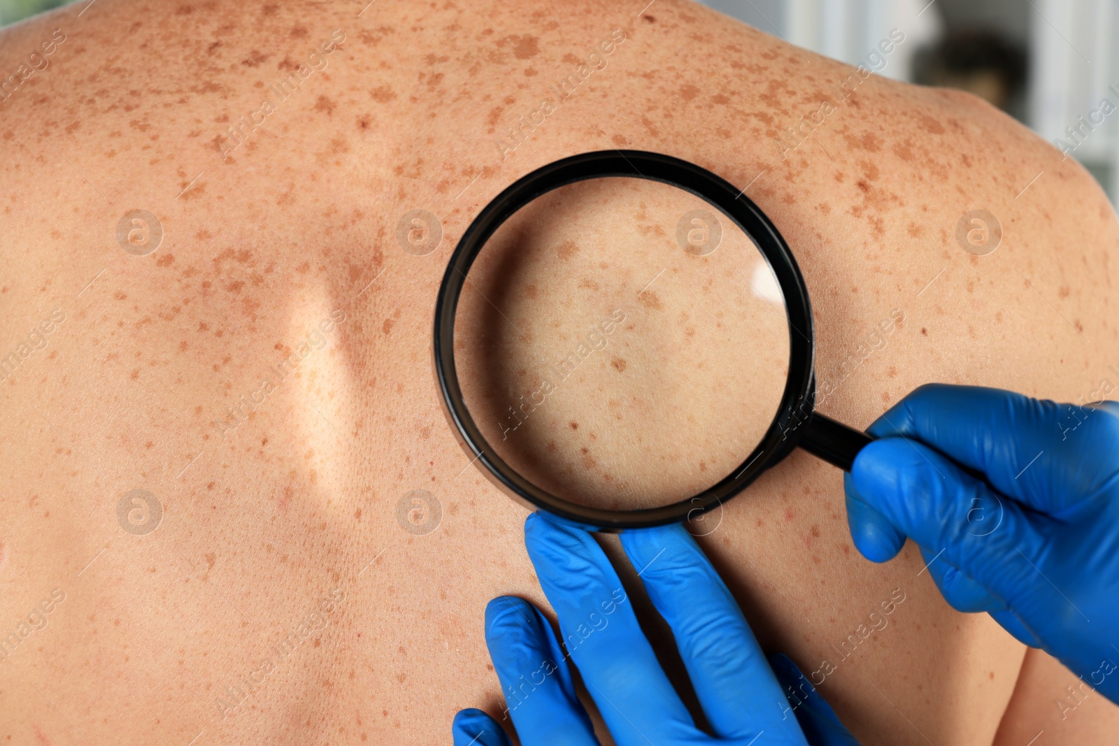 Photo of Dermatologist examining patient's birthmark with magnifying glass, closeup