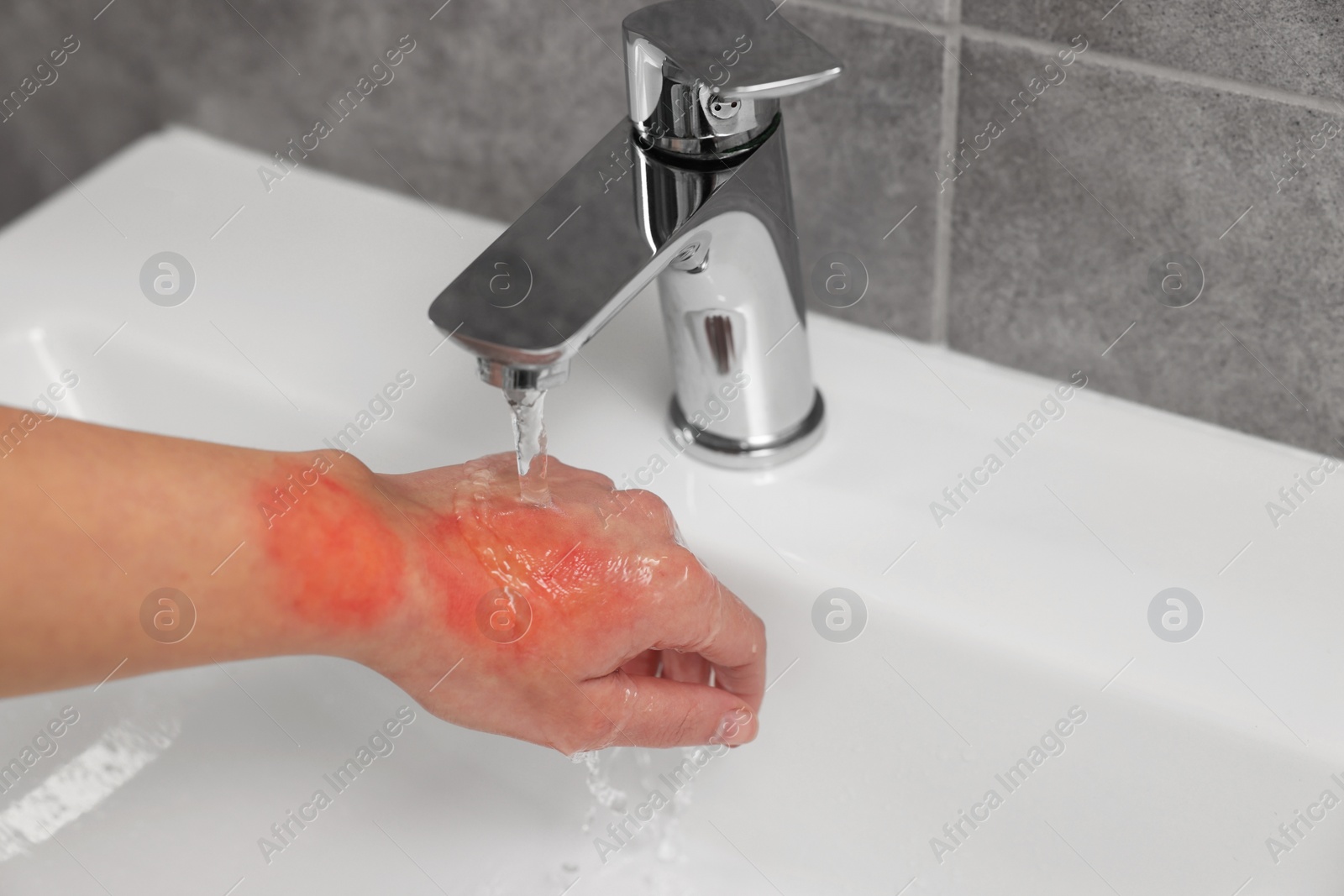 Photo of Woman holding burned hand under cold water indoors, closeup