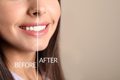 Image of Young woman before and after gingivoplasty procedure on beige background, closeup. Space for text