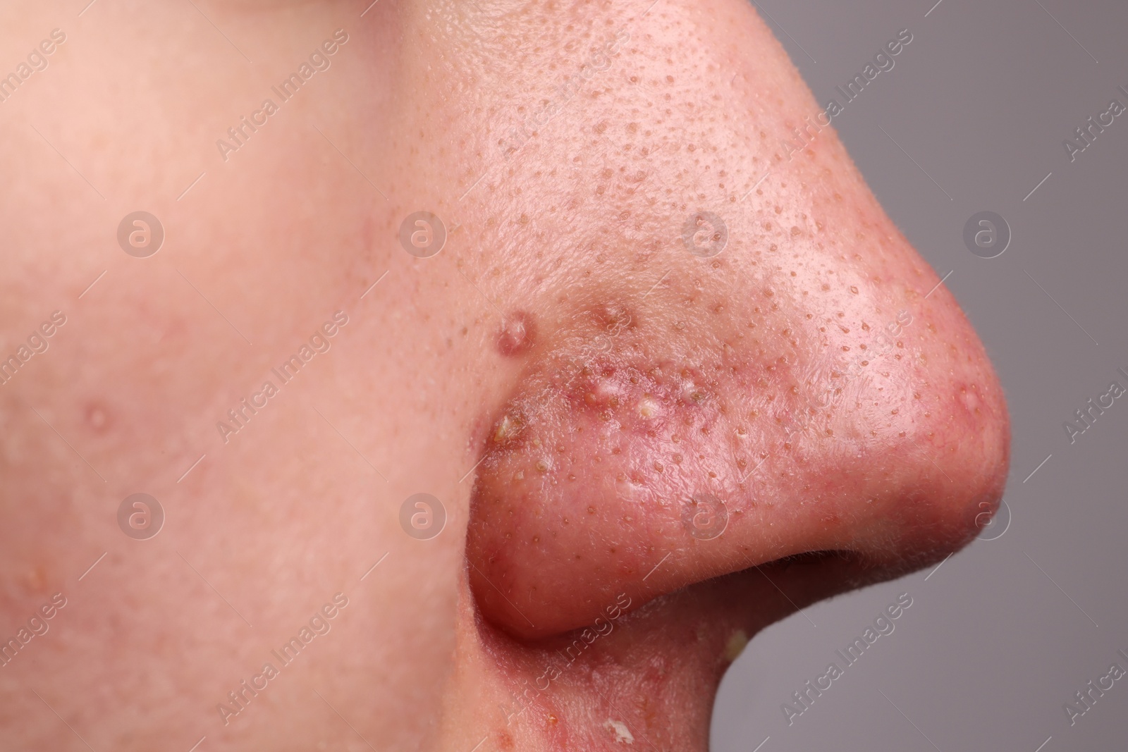 Photo of Young man with acne problem on grey background, closeup view of nose