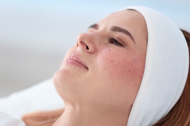 Photo of Woman after face biorevitalization procedure in salon, closeup. Cosmetic treatment