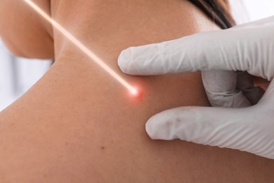 Laser mole removal. Doctor checking patient's skin during procedure in clinic, closeup