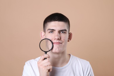 Young man with acne problem holding magnifying glass on beige background