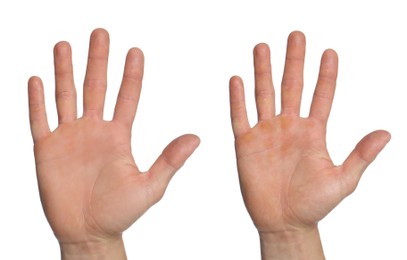 Image of Man showing hands without and with calluses on white background., closeup. Collage 