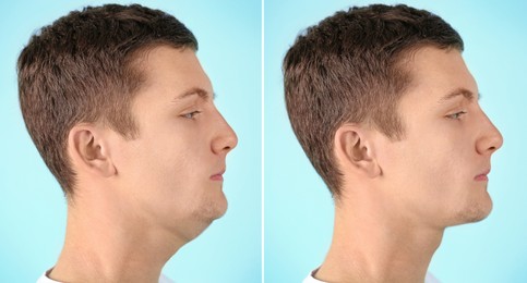 Double chin problem. Collage with photos of man before and after plastic surgery procedure on light blue background