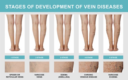 Image of Stages of development of vein diseases. Photos of woman and zoomed skin area, closeup. Collage design showing varicose veins, edema and other phases