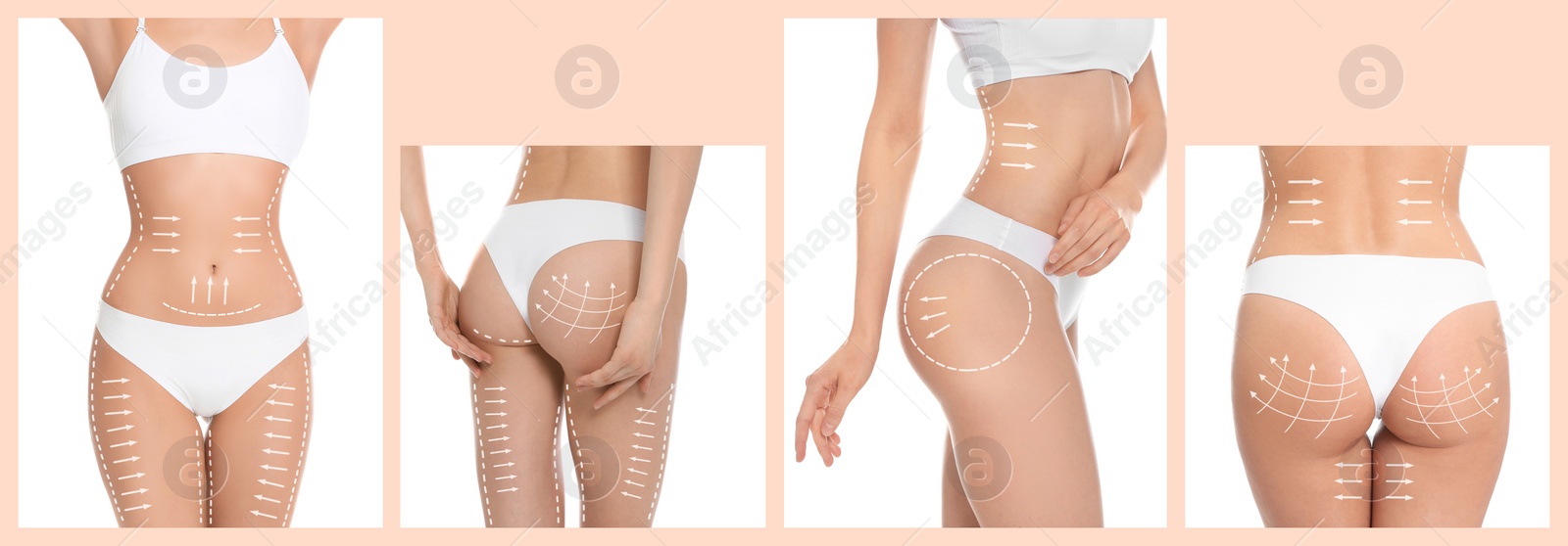 Image of Photos of young woman with marks on body against white background, collage. Cosmetic surgery concept