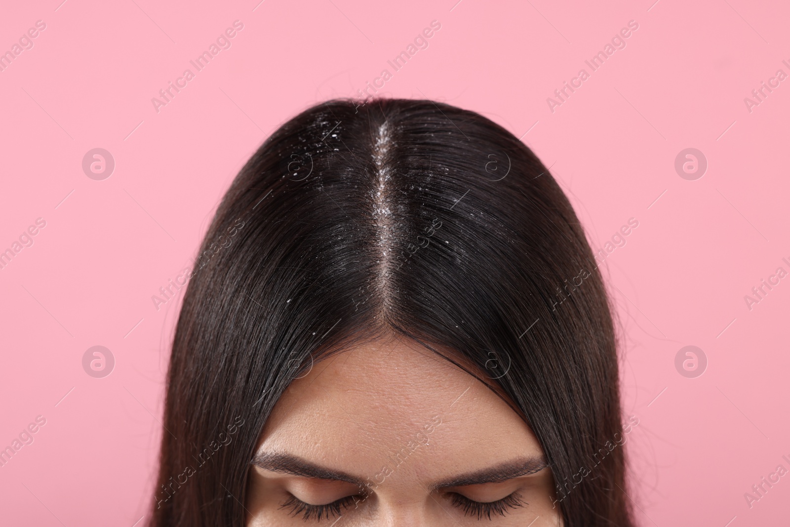 Photo of Woman with dandruff in her dark hair on pink background, closeup