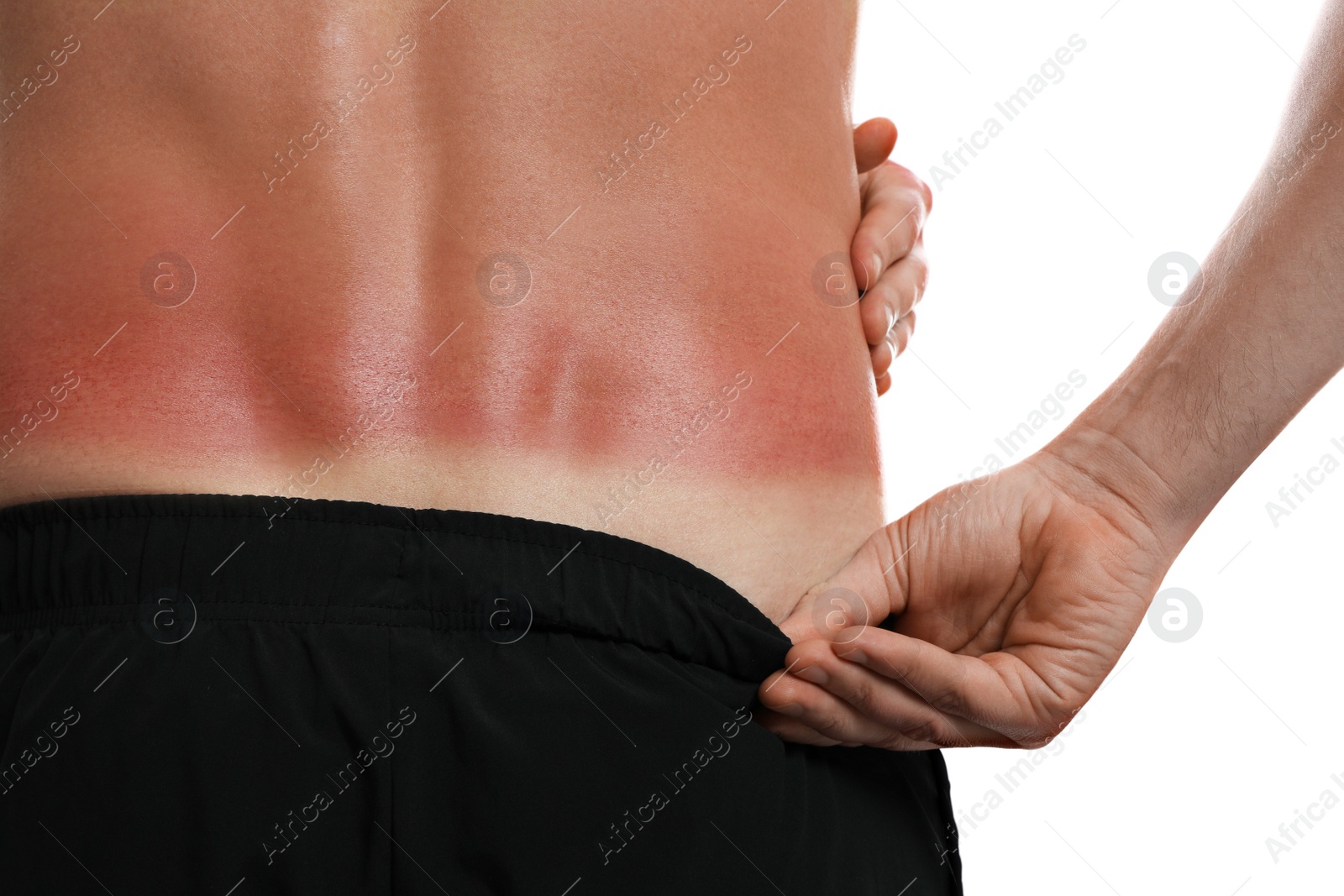 Photo of Man with sunburned skin on white background, closeup