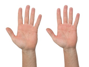 Man showing hands without and with calluses on white background., closeup. Collage 