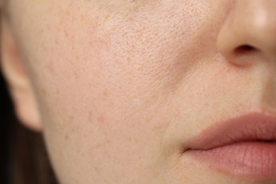 Macro view of woman with dry skin