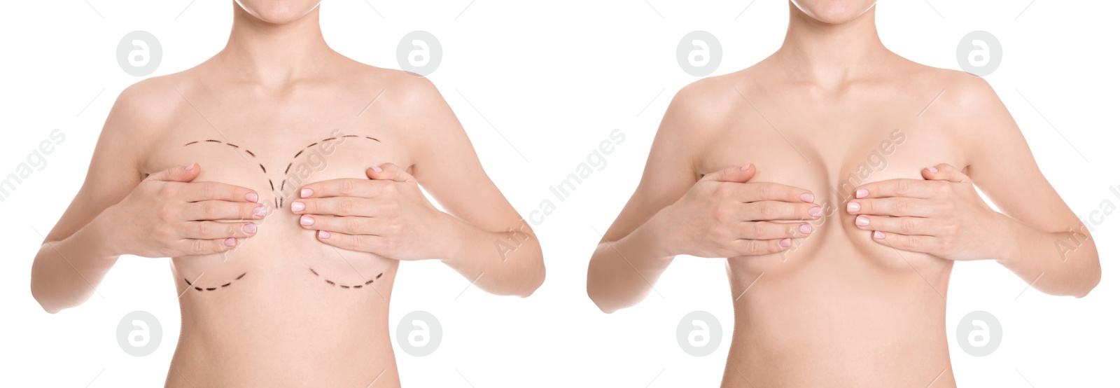Image of Breast augmentation with silicone implants. Collage with photos of woman before and after plastic surgery on white background, closeup