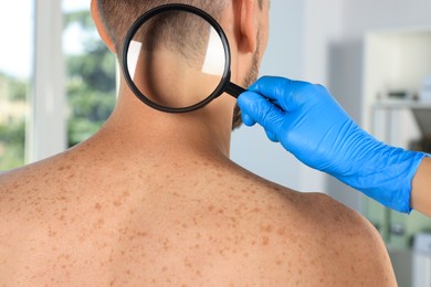 Dermatologist examining patient's birthmark with magnifying glass in clinic, closeup