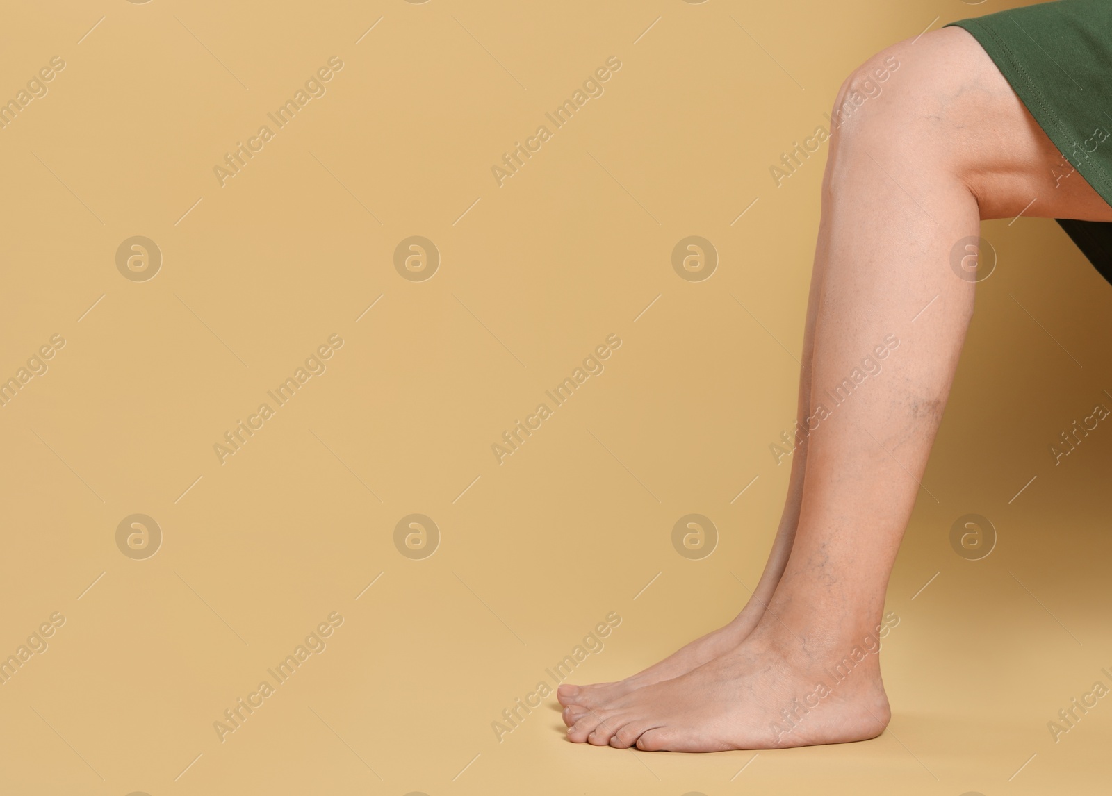 Photo of Closeup view of woman with varicose veins on yellow background. Space for text