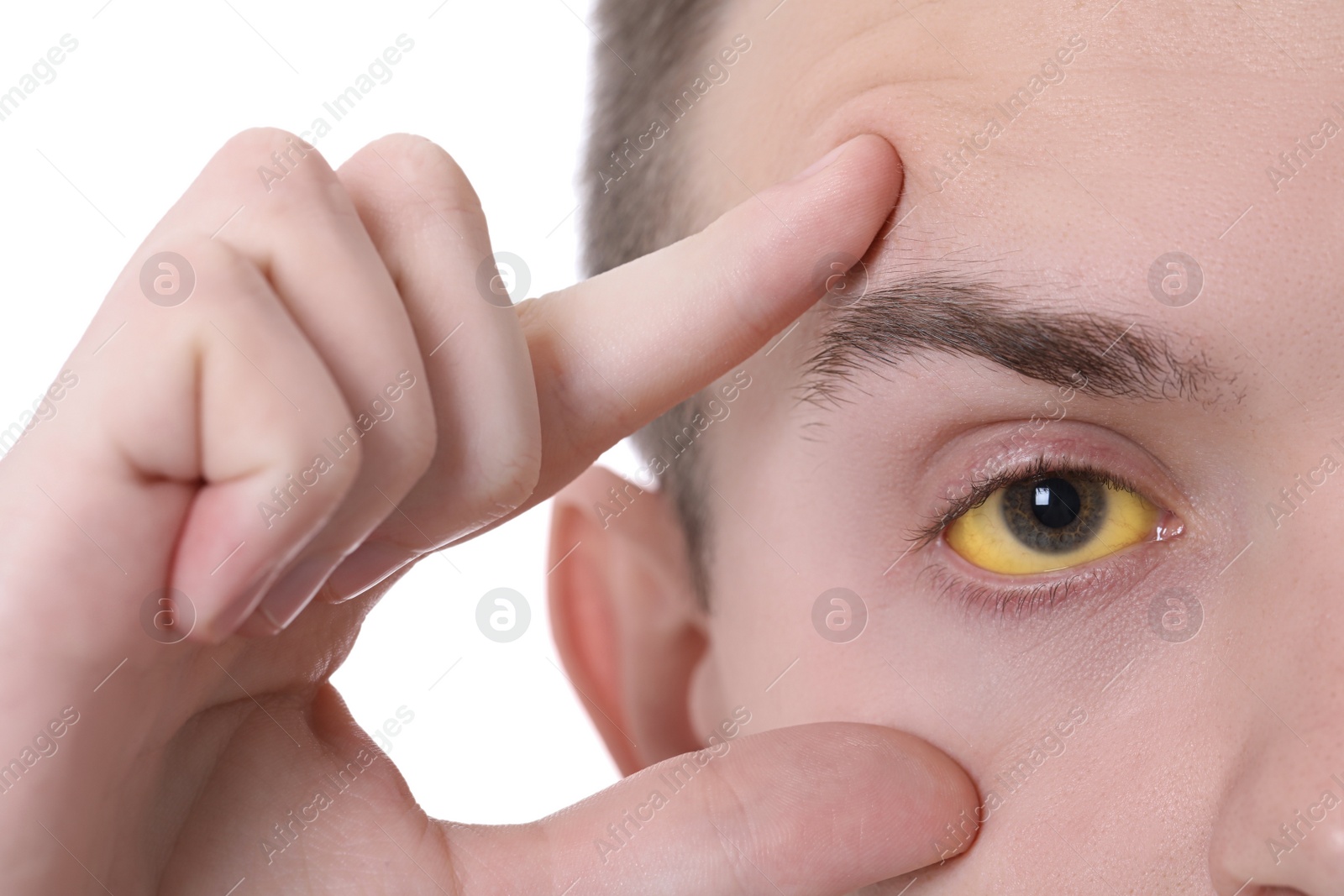 Photo of Man checking his health condition on white background, closeup. Yellow eyes as symptom of hepatitis