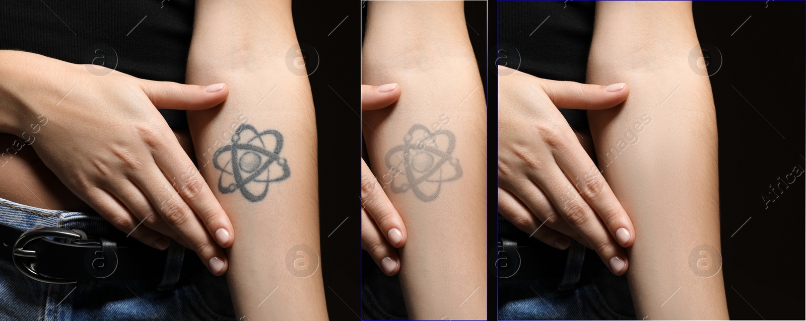 Image of Woman before and after laser tattoo removal procedures on black background, closeup. Collage with photos, banner design