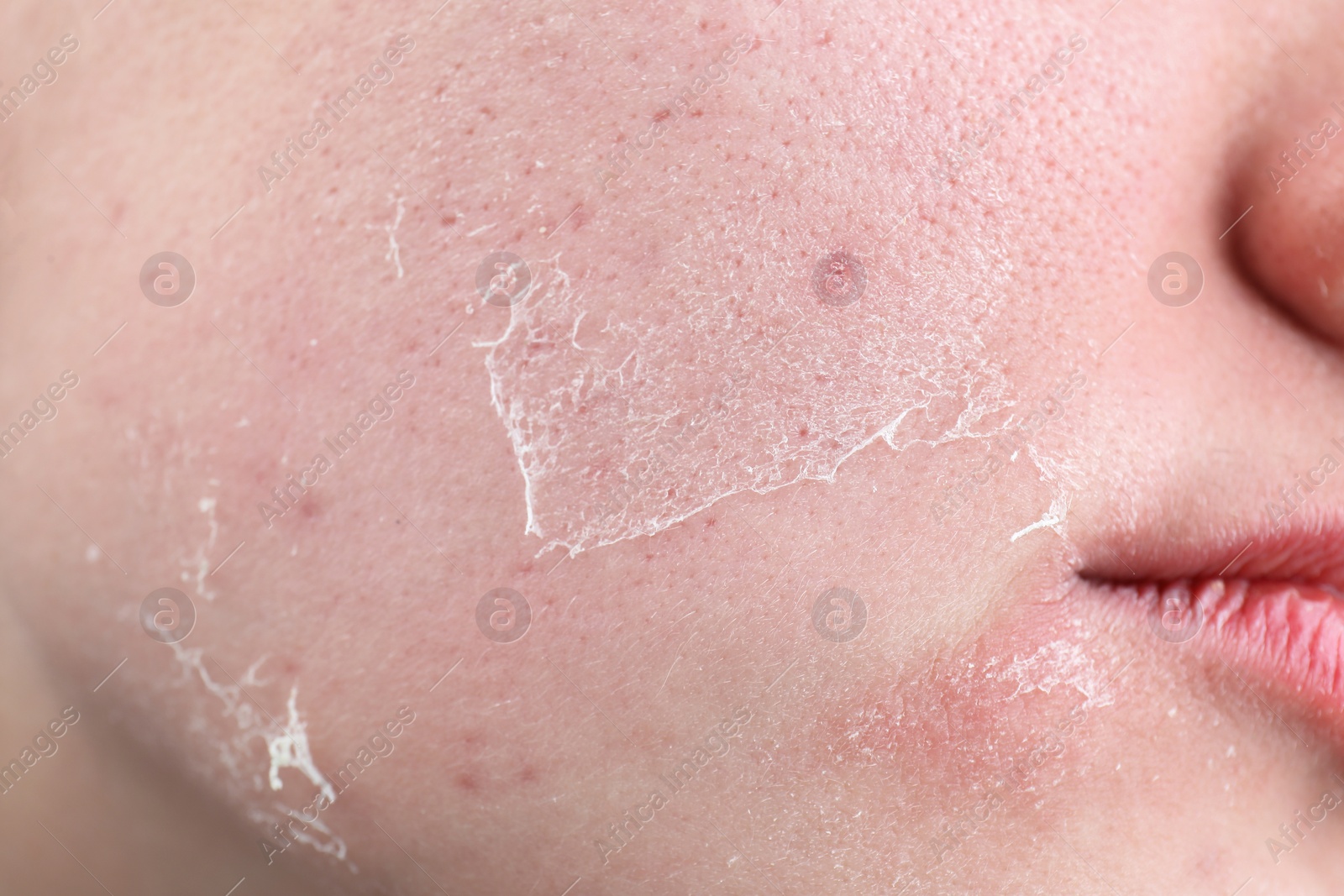 Photo of Woman with dry skin on face, closeup