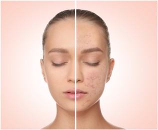 Young woman with acne problem before and after treatment on light background, collage