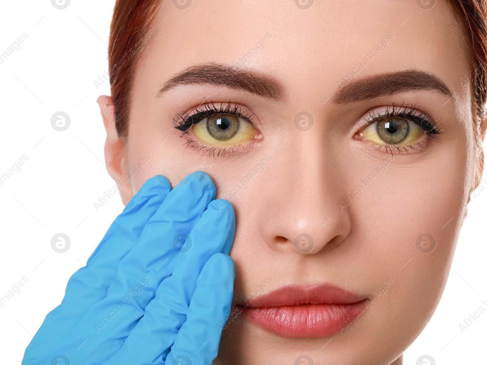 Photo of Doctor checking woman with yellow eyes on white background, closeup. Symptom of hepatitis