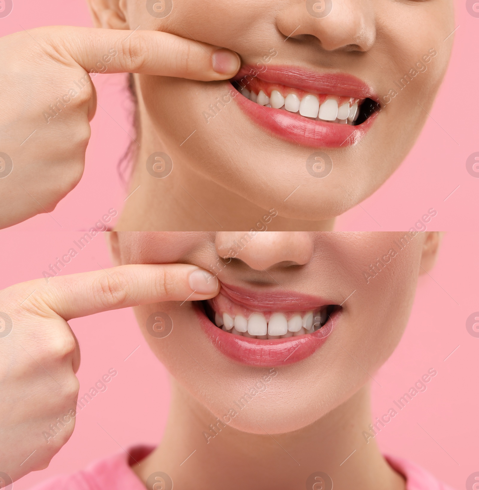 Image of Woman showing gum before and after treatment on pink background, collage of photos