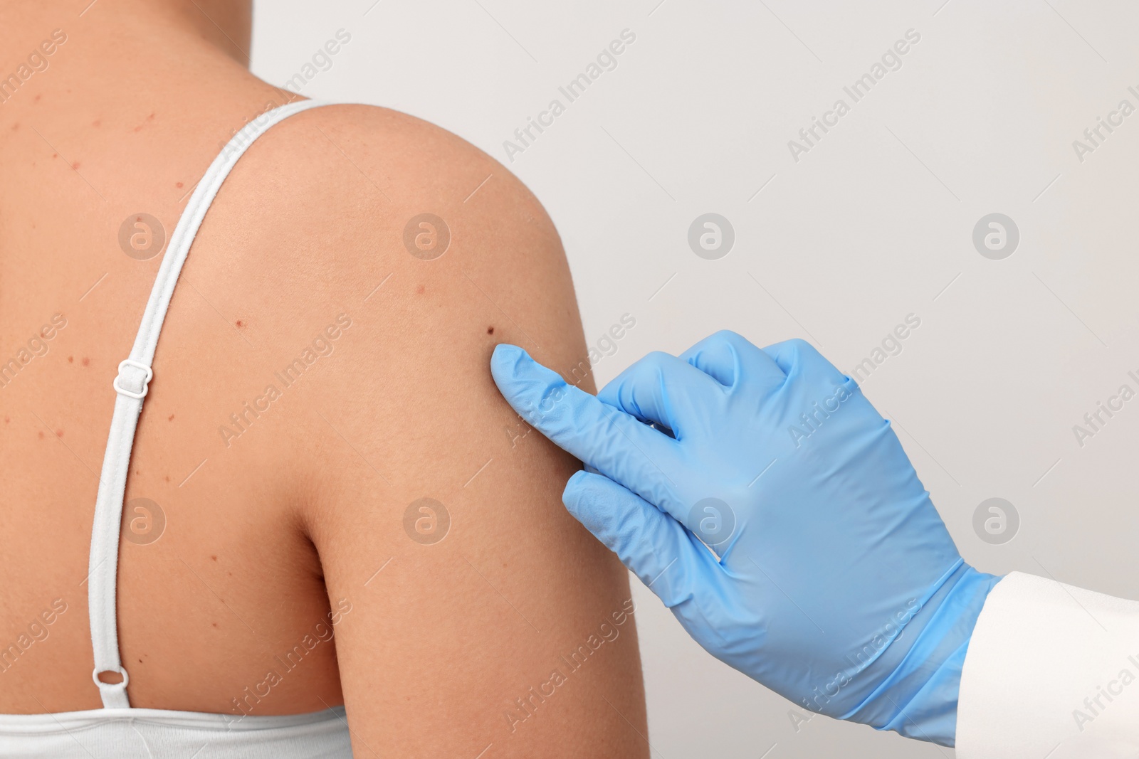 Photo of Dermatologist examining patient's birthmark on beige background, closeup