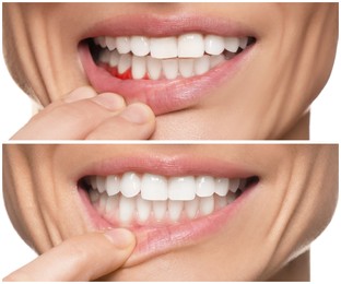 Image of Woman showing gum before and after treatment on white background, collage of photos