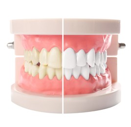 Image of Model of oral cavity with teeth before and after whitening on white background