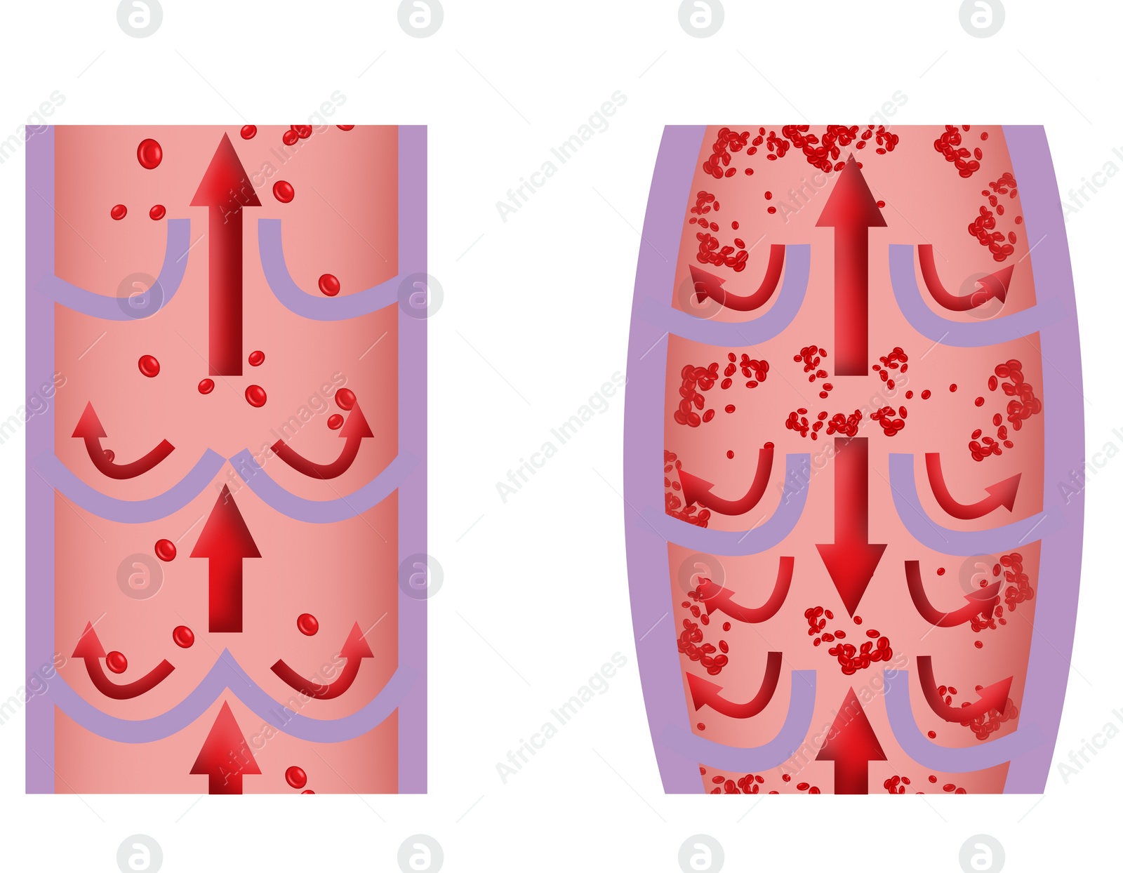 Illustration of Illustrations of damaged and healthy vein on white background, longitudinal section