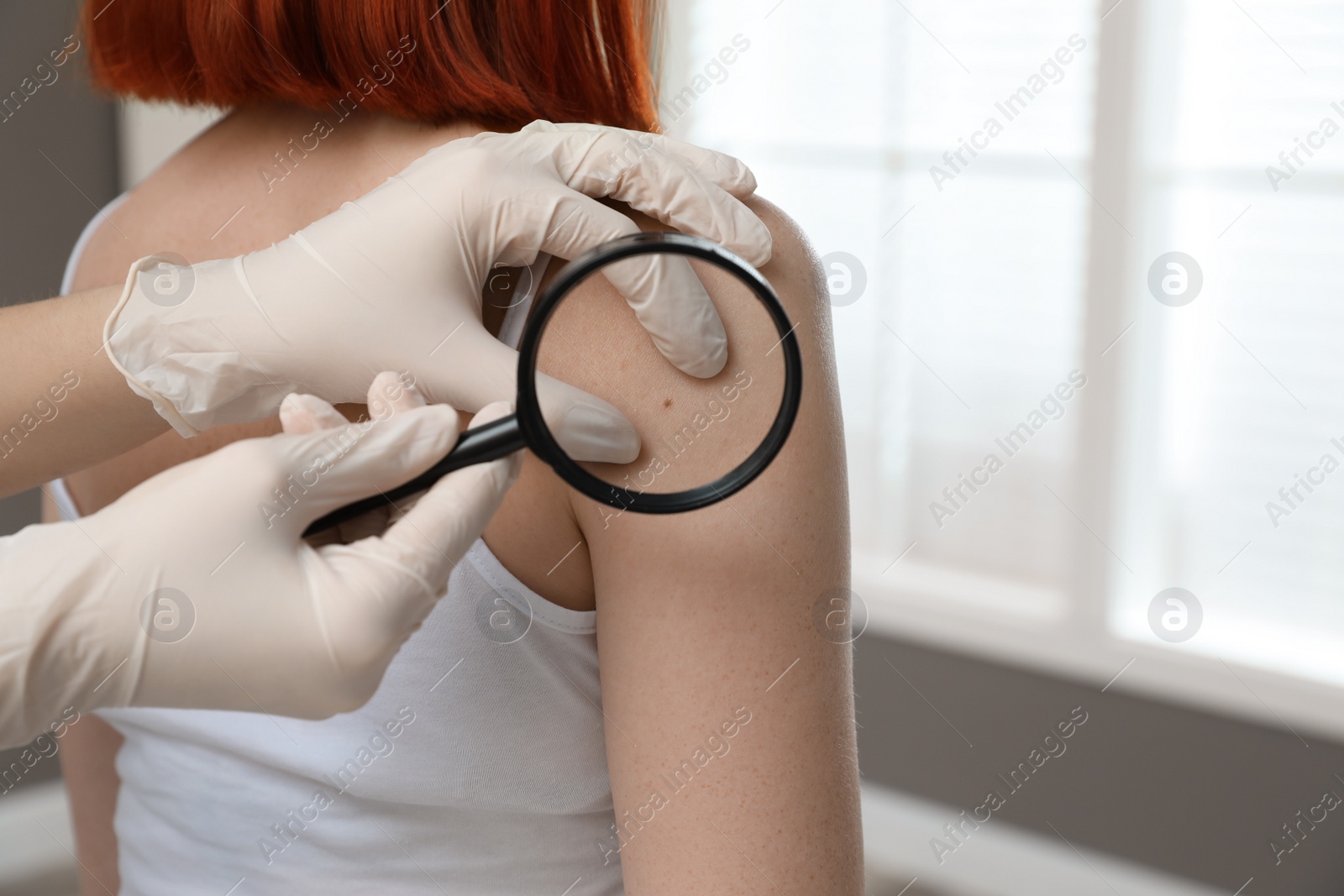 Photo of Dermatologist examining patient's birthmark with magnifying glass in clinic, closeup view