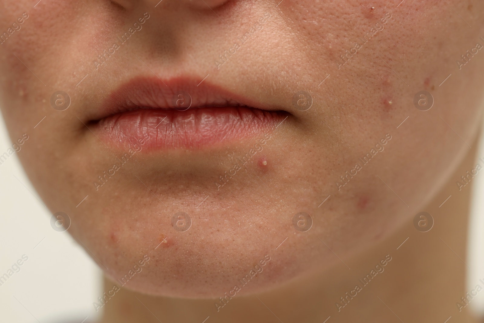 Photo of Young woman with acne on her face against white background, closeup
