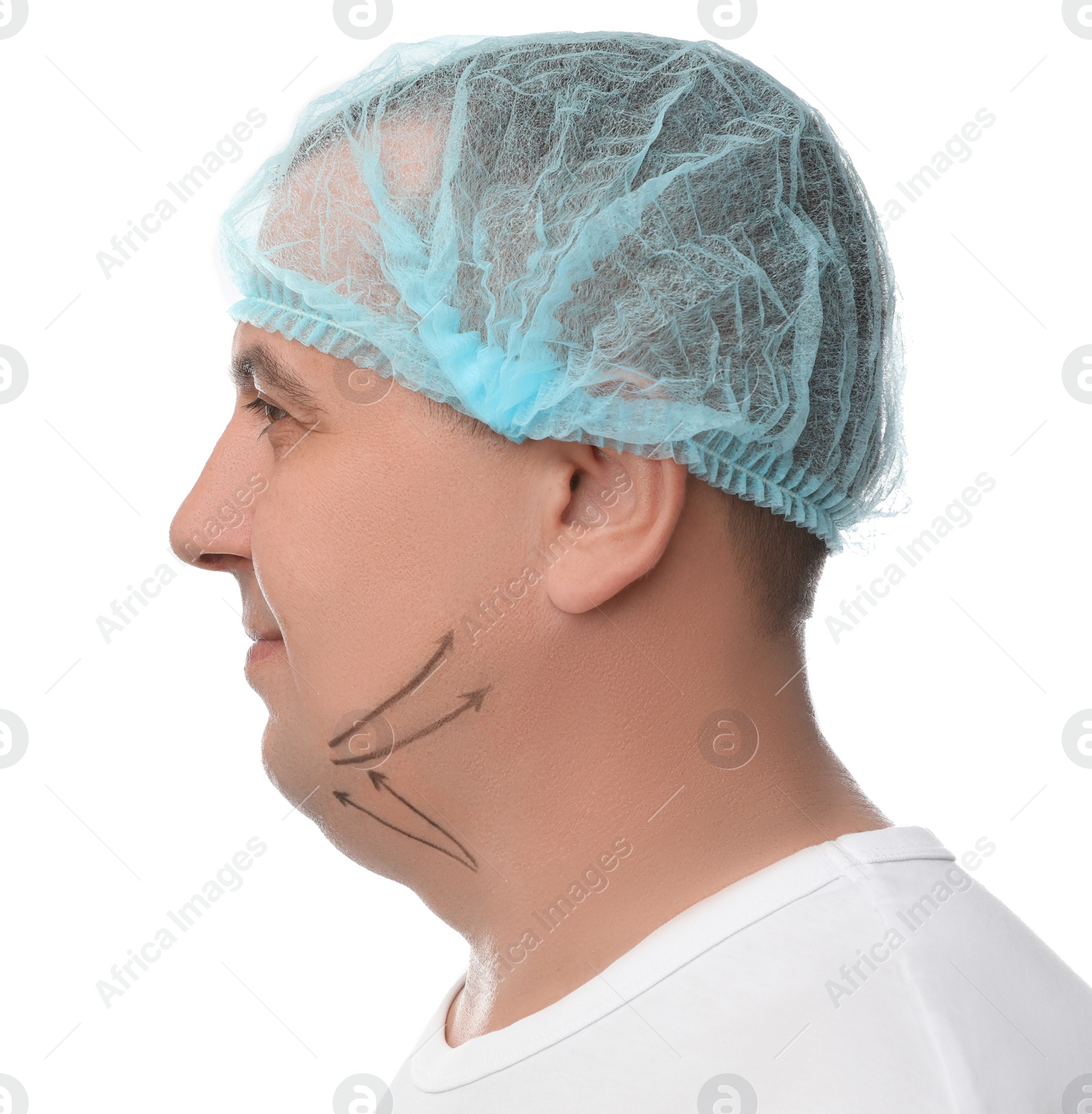 Photo of Mature man with marks on face against white background. Double chin removal