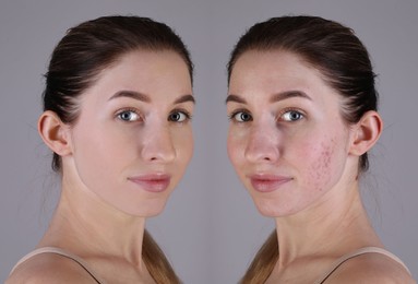 Acne problem. Young woman before and after treatment on grey background, collage of photos