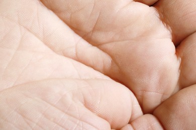 Photo of Closeup view of human hand with dry skin