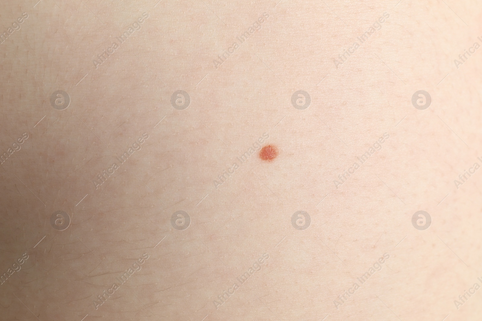 Photo of Closeup view of woman's body with birthmark