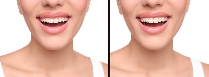 Image of Young woman before and after gingivoplasty procedure on white background, closeup. Banner design