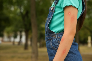 Photo of Girl with insect bites on arm in park, closeup. Space for text