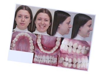 Photo of Photos of woman and her teeth from different sides isolated on white