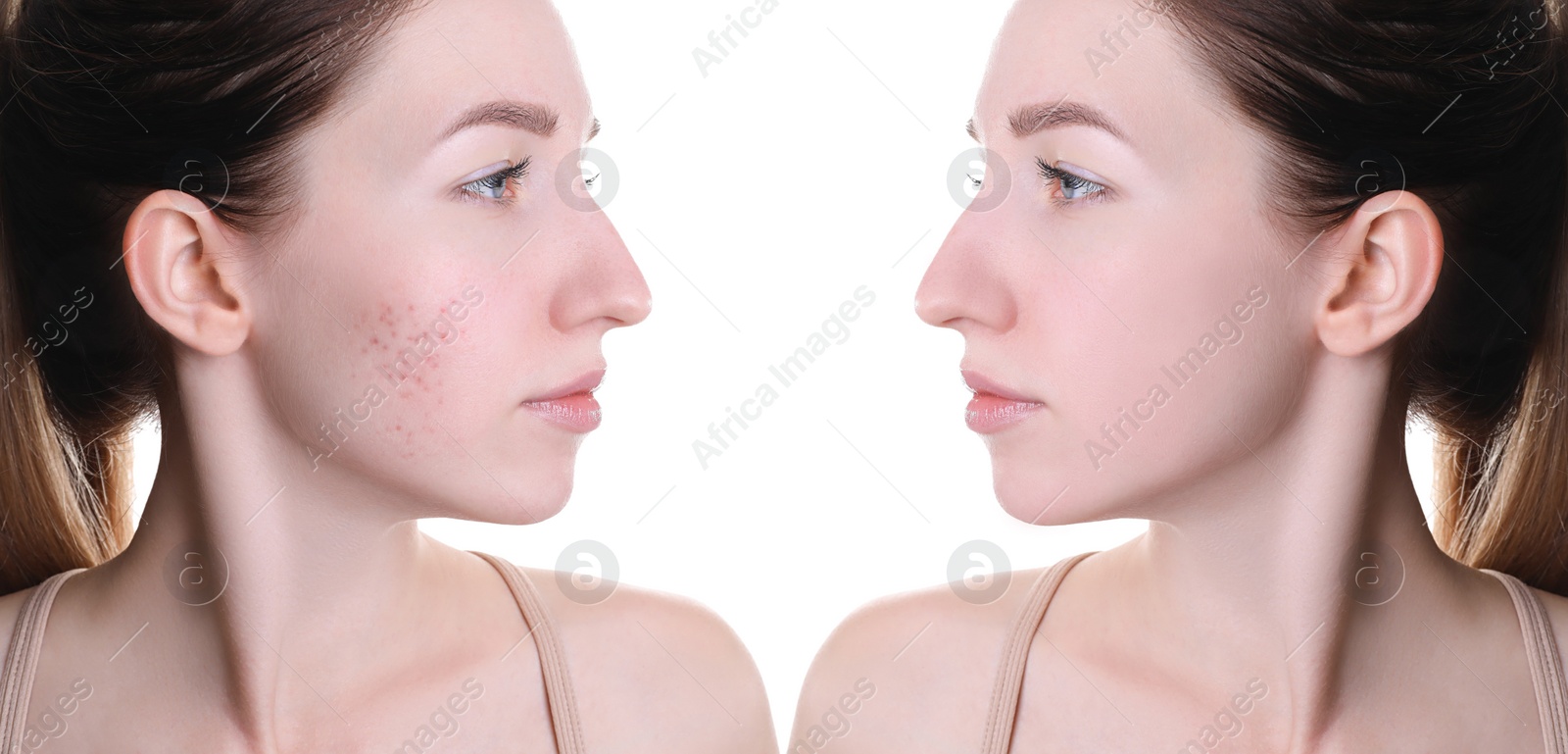 Image of Acne problem. Young woman before and after treatment on white background, collage of photos