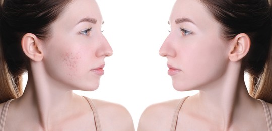 Acne problem. Young woman before and after treatment on white background, collage of photos