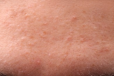 Photo of Young woman with acne problem, closeup view